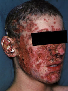 acne-5-771320.jpg