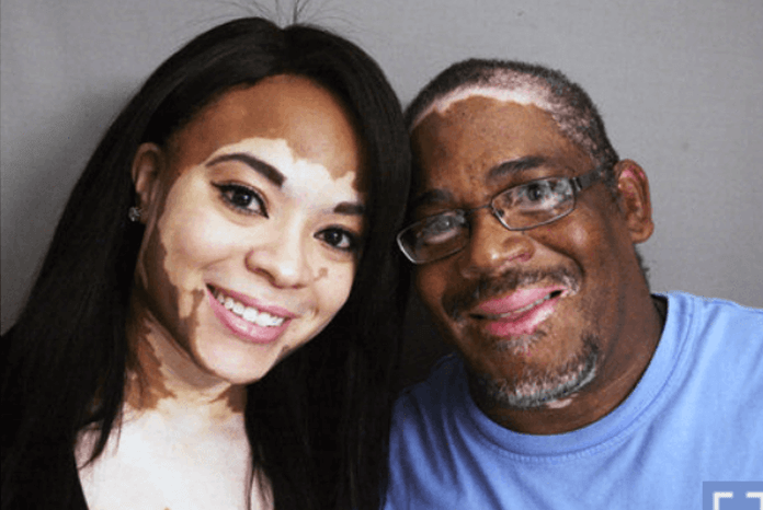 will-my-children-family-get-vitiligo-vitiligo-clinic-and-research-center-blog-post.png